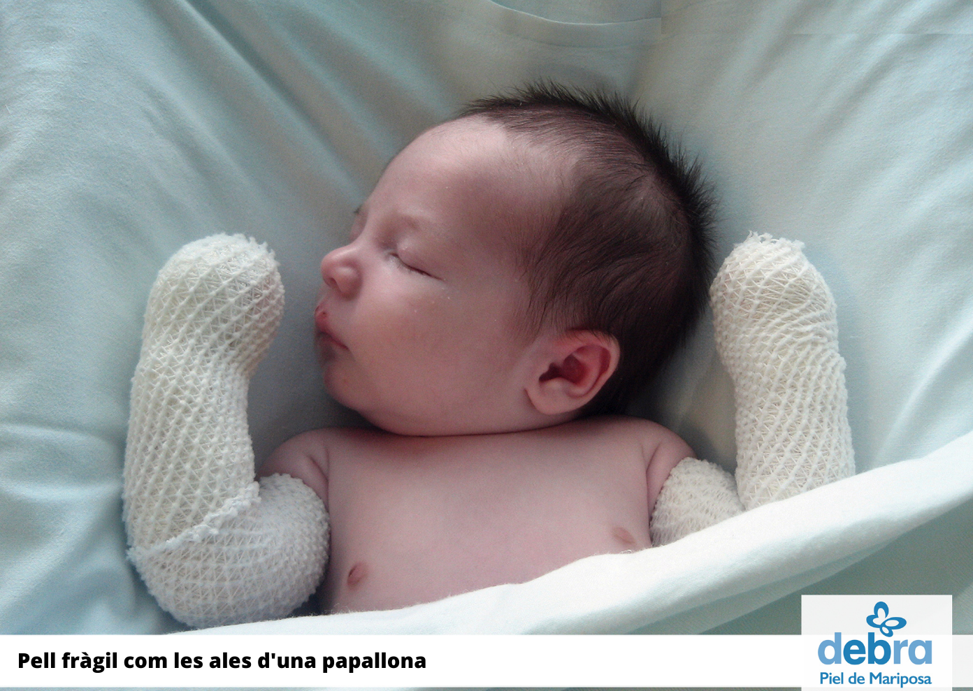 Peu de foto, logo de l’Associació DEBRA-PIEL de Mariposa. Fotografia d’un nadó al llit amb els dos braços embenats.