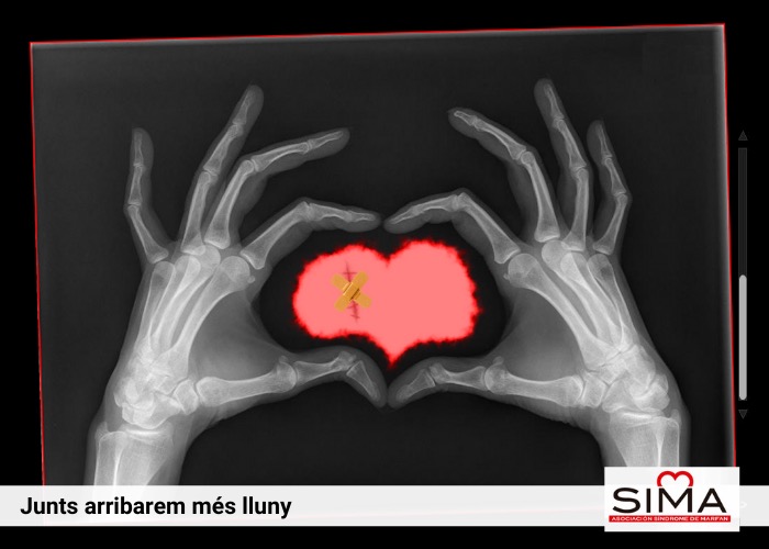 Peu de foto, logo de l'Associació d'Afectats per la Síndrome Marfan a Catalunya. Fotografia de dues mans vistes des d’una imatge de radiografia fent la forma d’un cor.